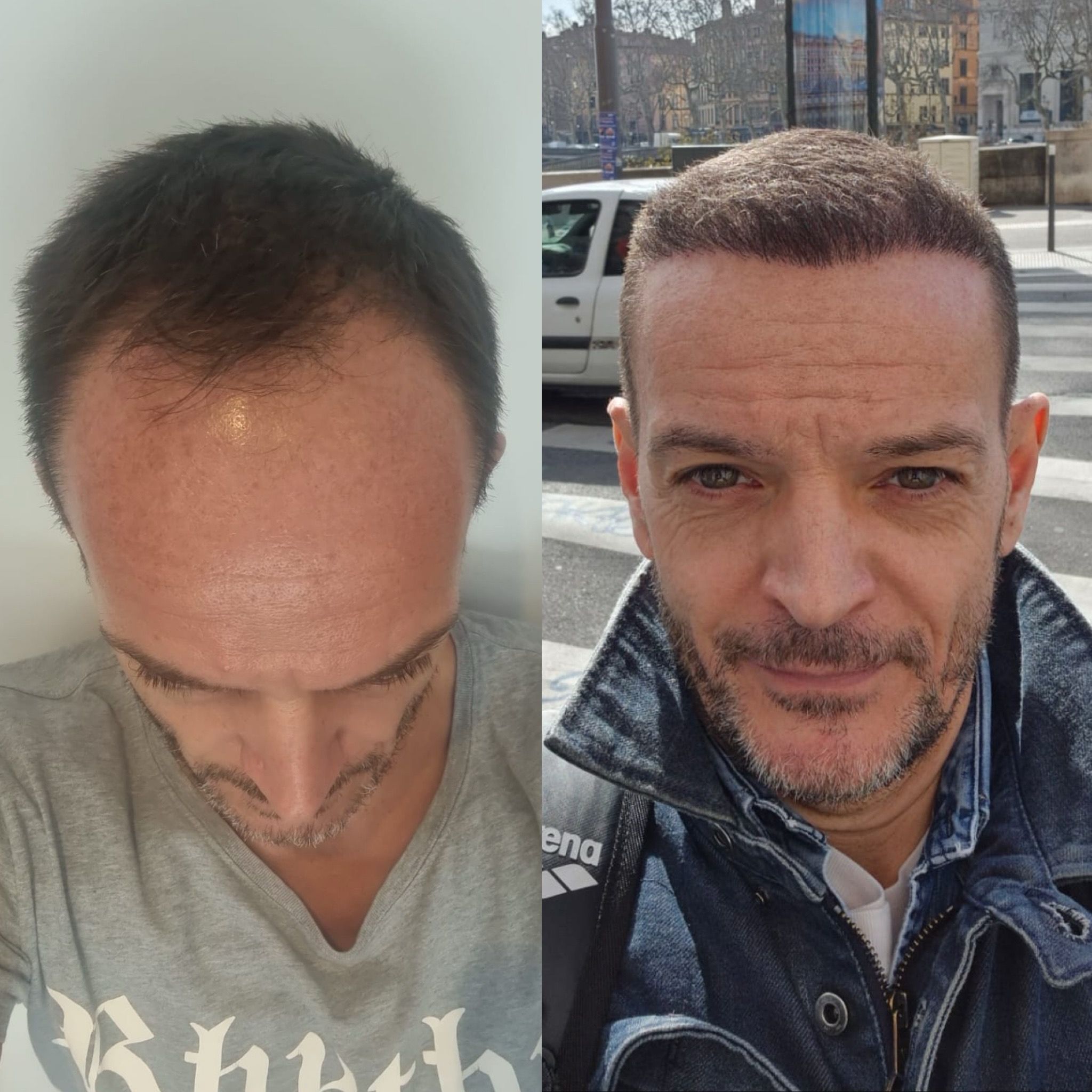 Résultat avant et après greffe de cheveux